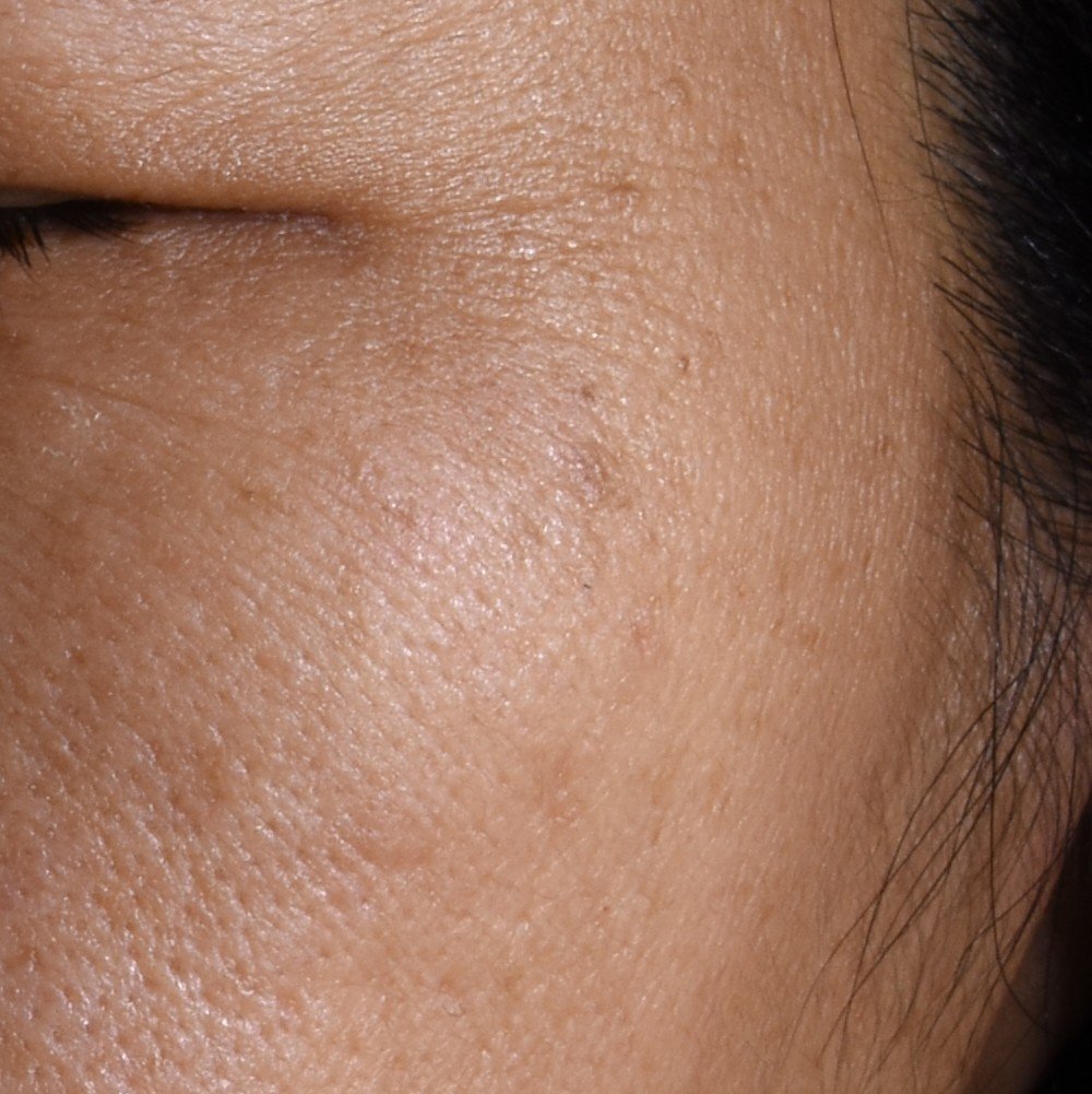 20251105 Oap Revitalift Laser Melasyl Creamy Serum Before Dmi Ecomm Img 1000x1000